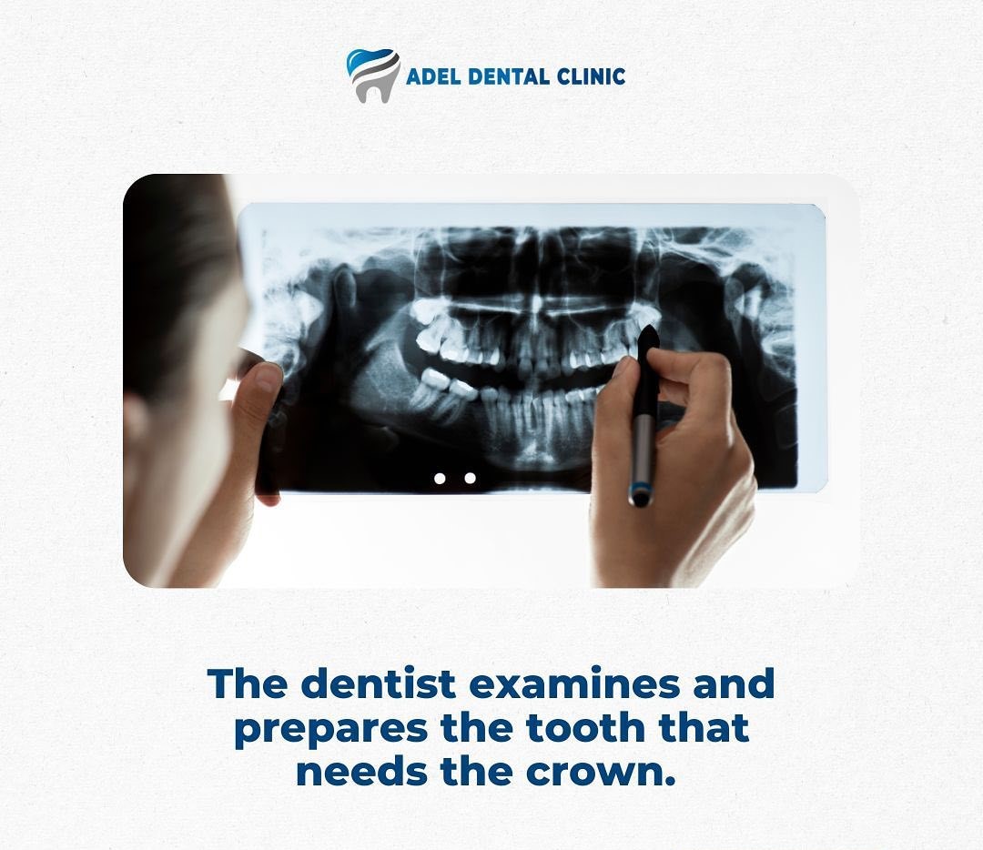 dental crown procedure in Antalya-Turkey